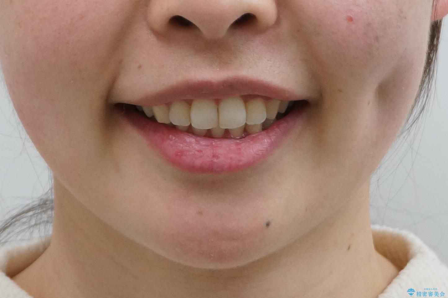 出っ歯の治療 抜かずに 短期間で目立たない治療の治療後(顔貌)
