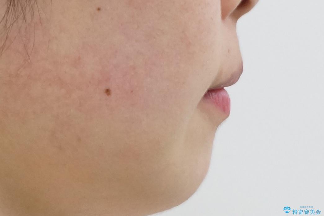 出っ歯の治療 抜かずに 短期間で目立たない治療の治療後(顔貌)