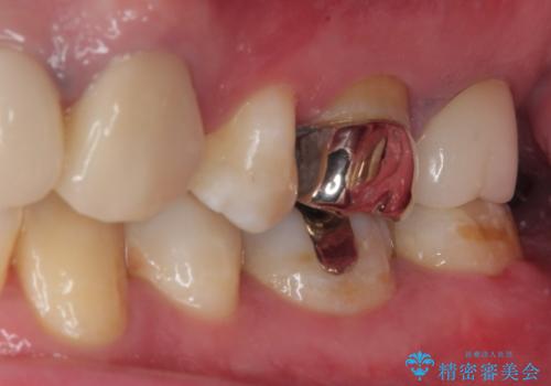 詰め物が欠けて虫歯になってる気がする セラミックインレー修復の治療後
