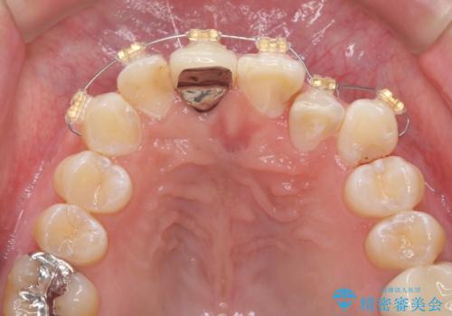 奥に引っ込んでいる前歯を並べたい 矯正治療とセラミック治療の治療中