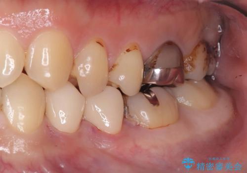 CRの劣化による虫歯|虫歯治療|セラミッククラウン|審美回復|神経を残す治療の治療後