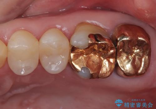 銀歯が取れた セラミックインレー修復の治療後