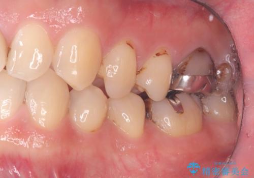 CRの劣化による虫歯|虫歯治療|セラミッククラウン|審美回復|神経を残す治療の治療前