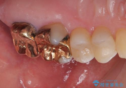 銀歯が取れた セラミックインレー修復の治療後