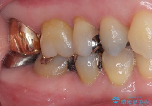 詰め物が欠けた ハイブリッドインレー修復の治療前