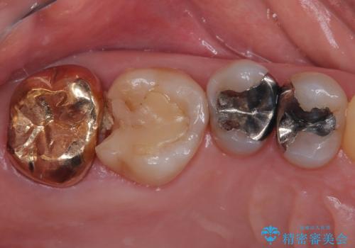 詰め物が欠けた ハイブリッドインレー修復の治療前