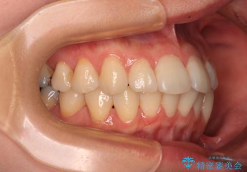 上下前歯のデコボコ ワイヤー装置で楽ちん矯正治療の治療前