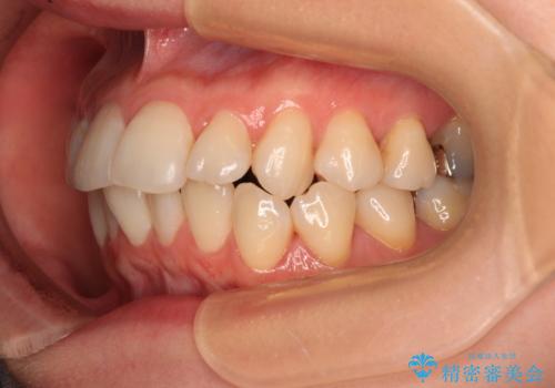 上下前歯のデコボコ ワイヤー装置で楽ちん矯正治療の治療前