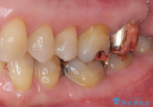 銀歯が取れた セラミックインレー修復の治療後