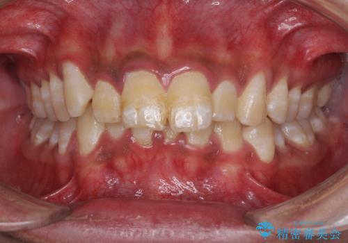 深い咬み合わせと前歯のデコボコ ワイヤー装置での抜歯矯正の症例 治療前