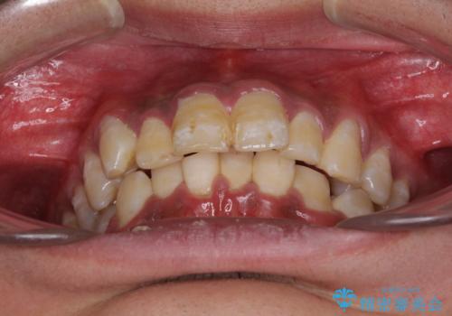 深い咬み合わせと前歯のデコボコ ワイヤー装置での抜歯矯正の治療前