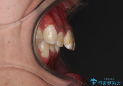 深い咬み合わせと前歯のデコボコ ワイヤー装置での抜歯矯正の治療前