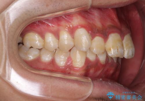 深い咬み合わせと前歯のデコボコ ワイヤー装置での抜歯矯正の治療前