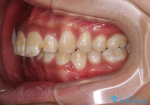 深い咬み合わせと前歯のデコボコ ワイヤー装置での抜歯矯正の治療前