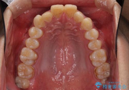 深い咬み合わせと前歯のデコボコ ワイヤー装置での抜歯矯正の治療前