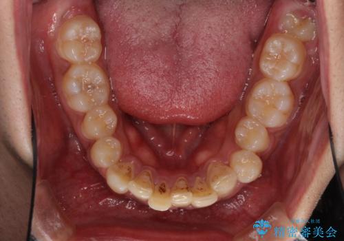 深い咬み合わせと前歯のデコボコ ワイヤー装置での抜歯矯正の治療前