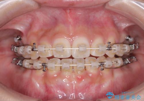 上下非接触の前歯 口元の突出感を改善する抜歯矯正の治療中