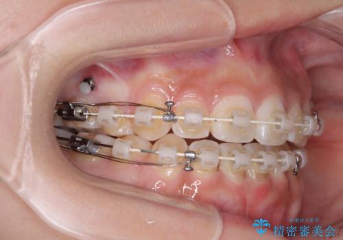 上下非接触の前歯 口元の突出感を改善する抜歯矯正の治療中
