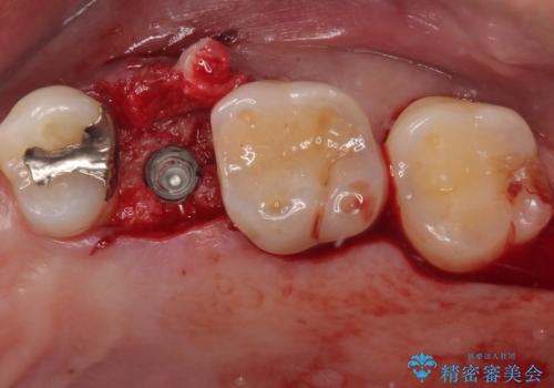 手術が怖くて抜いたままの奥歯に歯を 1DAYインプラント治療の治療後