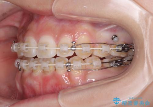 上下非接触の前歯 口元の突出感を改善する抜歯矯正の治療中