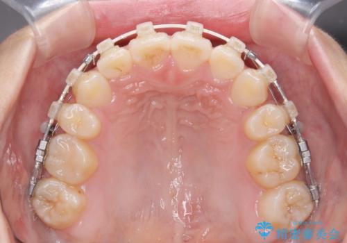 上下非接触の前歯 口元の突出感を改善する抜歯矯正の治療中