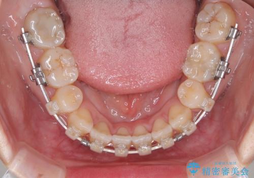 上下非接触の前歯 口元の突出感を改善する抜歯矯正の治療中