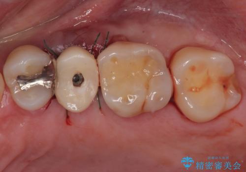 手術が怖くて抜いたままの奥歯に歯を 1DAYインプラント治療の治療中