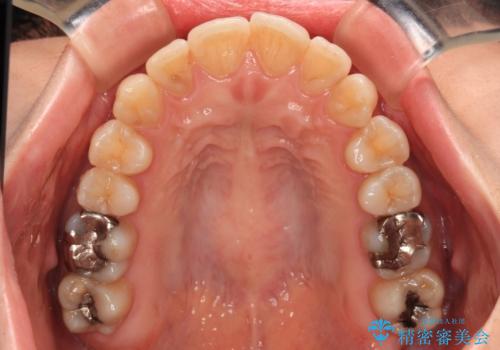 上下前歯のデコボコ ワイヤー装置で楽ちん矯正治療の治療前