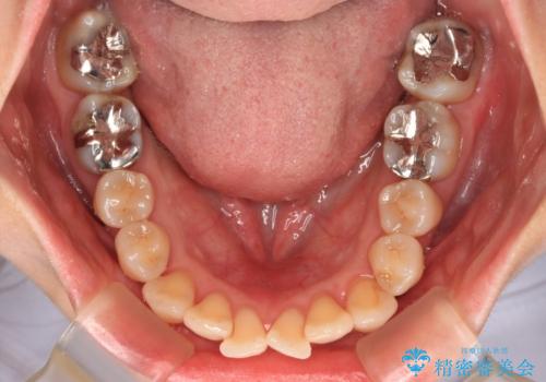 上下前歯のデコボコ ワイヤー装置で楽ちん矯正治療の治療前