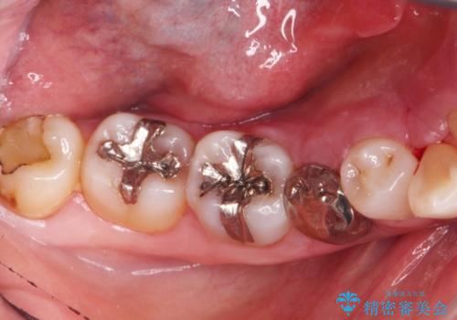 骨隆起の切除の治療後