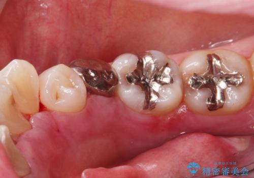 骨隆起の切除の治療後