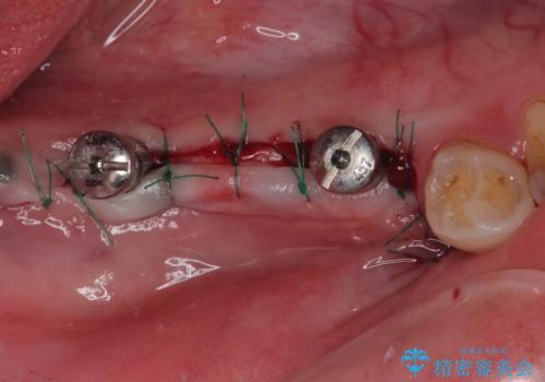 奥歯がぐらぐらする インプラントによる補綴治療の治療中