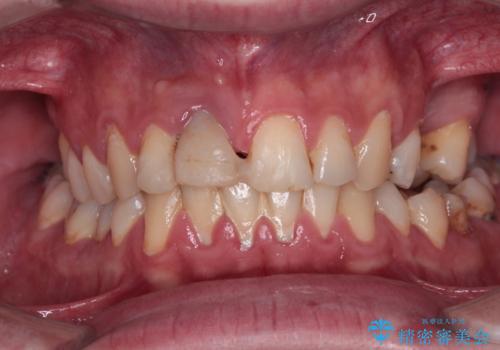 首の皮一枚で繋がっている前歯 1DAYインプラントでスムーズに治療の治療前