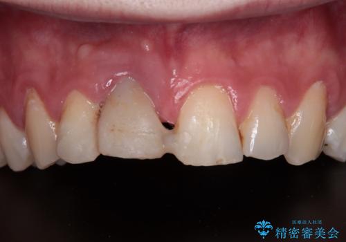 首の皮一枚で繋がっている前歯 1DAYインプラントでスムーズに治療の症例 治療前