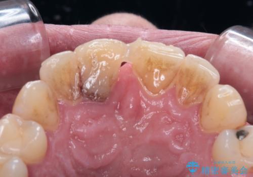 首の皮一枚で繋がっている前歯 1DAYインプラントでスムーズに治療の治療前