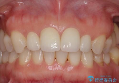 前歯が大きいのが気になる セラミックで整えたいの治療後