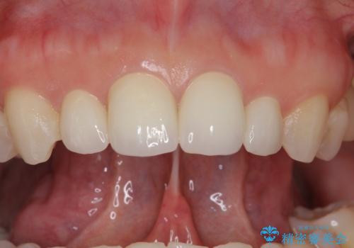 前歯が大きいのが気になる セラミックで整えたいの治療後
