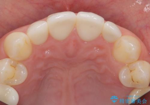前歯が大きいのが気になる セラミックで整えたいの治療後
