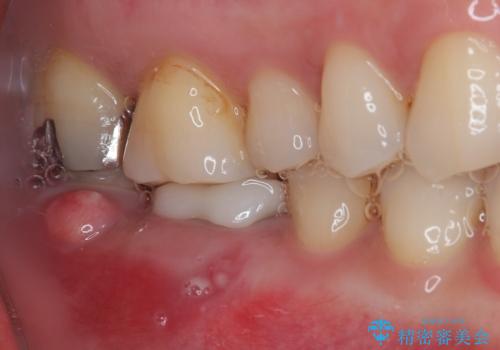 破折して抜歯が必要となった奥歯 オールセラミックブリッジ治療の治療前