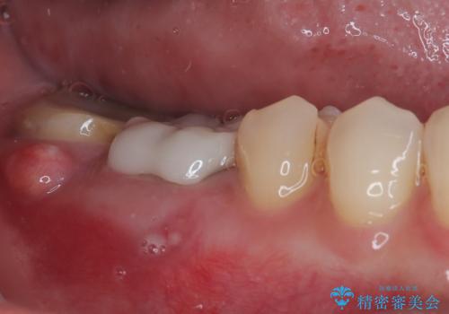 破折して抜歯が必要となった奥歯 オールセラミックブリッジ治療