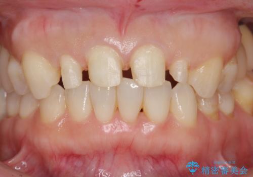 前歯が大きいのが気になる セラミックで整えたいの治療中