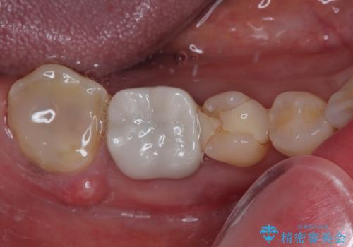 破折して抜歯が必要となった奥歯 オールセラミックブリッジ治療の症例 治療前
