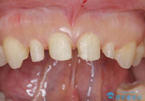 前歯が大きいのが気になる セラミックで整えたいの治療中