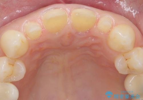 前歯が大きいのが気になる セラミックで整えたいの治療中