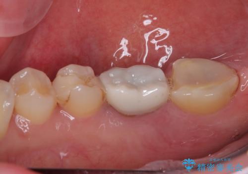 破折して抜歯が必要となった奥歯 オールセラミックブリッジ治療の治療前