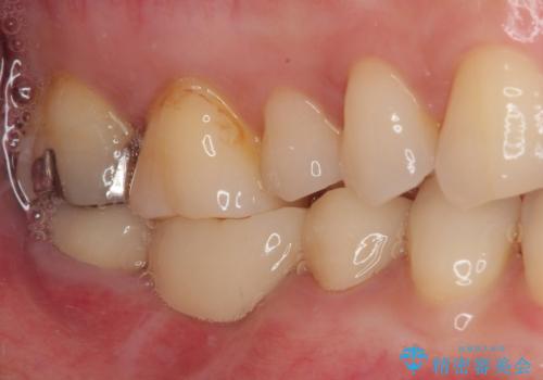破折して抜歯が必要となった奥歯 オールセラミックブリッジ治療の治療後