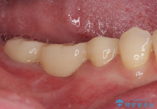 破折して抜歯が必要となった奥歯 オールセラミックブリッジ治療の治療後