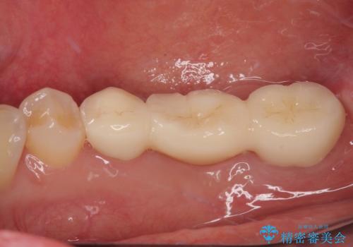 破折して抜歯が必要となった奥歯 オールセラミックブリッジ治療の治療後