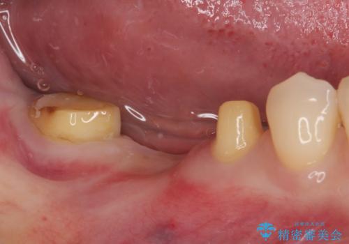 破折して抜歯が必要となった奥歯 オールセラミックブリッジ治療の治療中