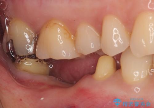 破折して抜歯が必要となった奥歯 オールセラミックブリッジ治療の治療中